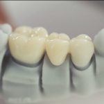 3D printing: The Mega Trend in Dentistry