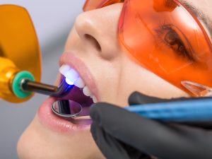 Composite Restoration