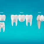 Dental Crowns & Bridges
