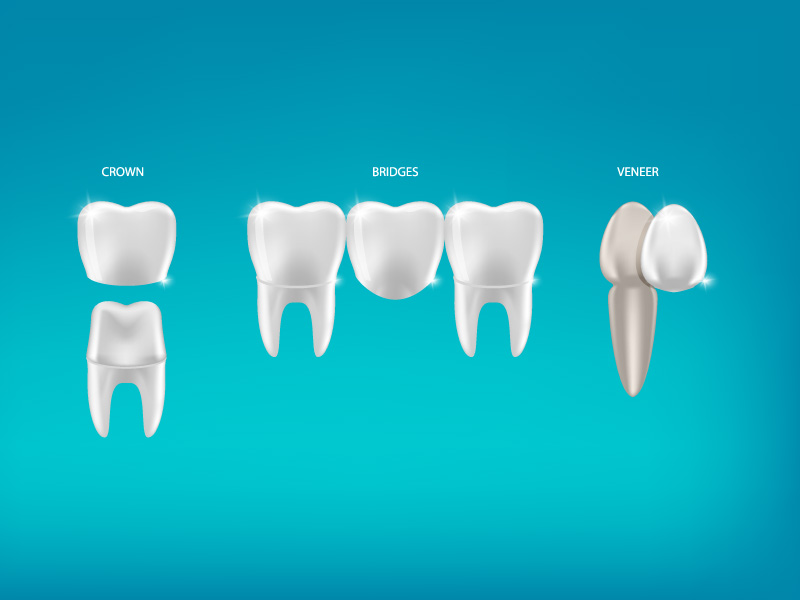 Retainers