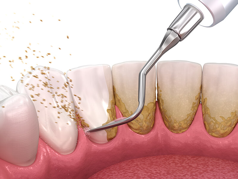 Retainers
