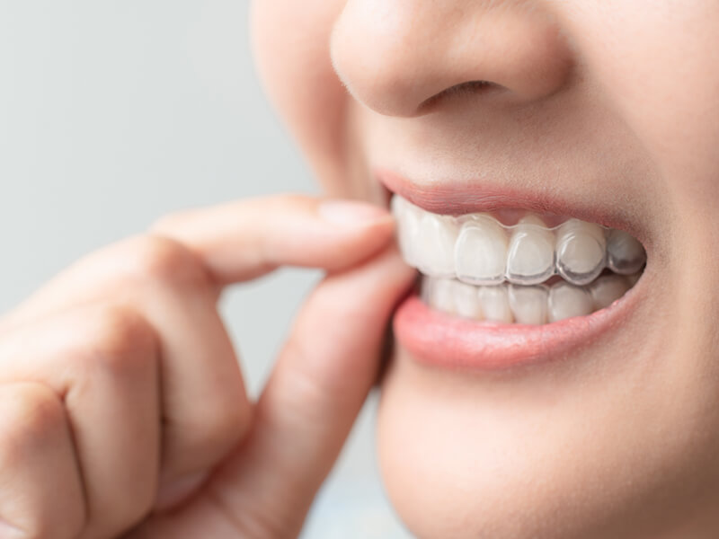 Retainers