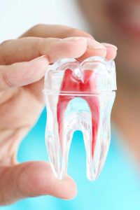 Root Canal Treatment