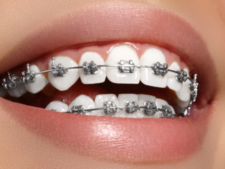 Orthodontics – Services for Aligning Teeth