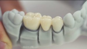 3D printing: The Mega Trend in Dentistry