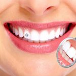 Therapeutic Prophylaxis