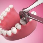 Tooth Extraction