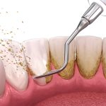 Therapeutic Prophylaxis