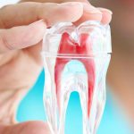 Root Canal Treatment
