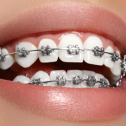 Orthodontics - Services for Aligning Teeth